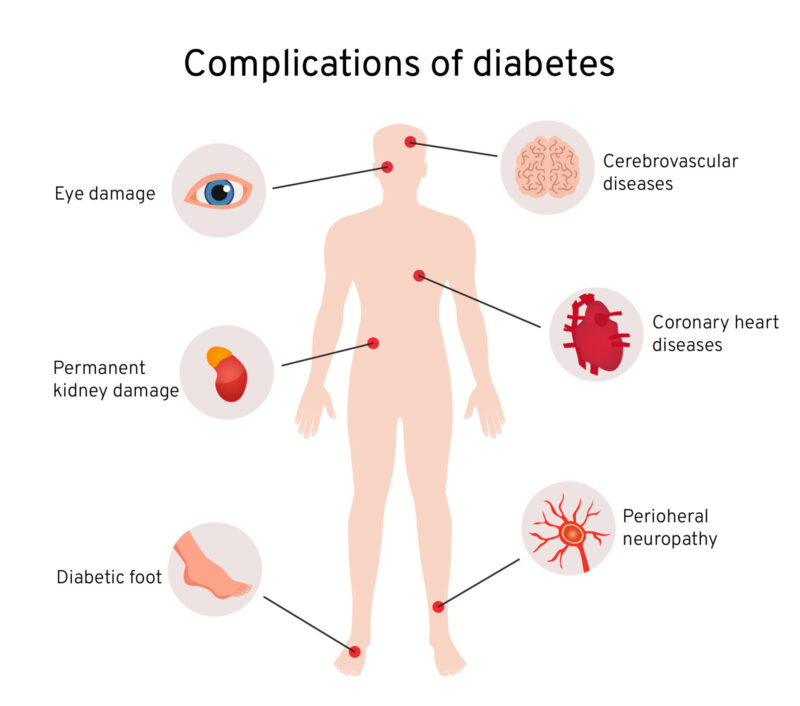 Illustraton of diabetes complications